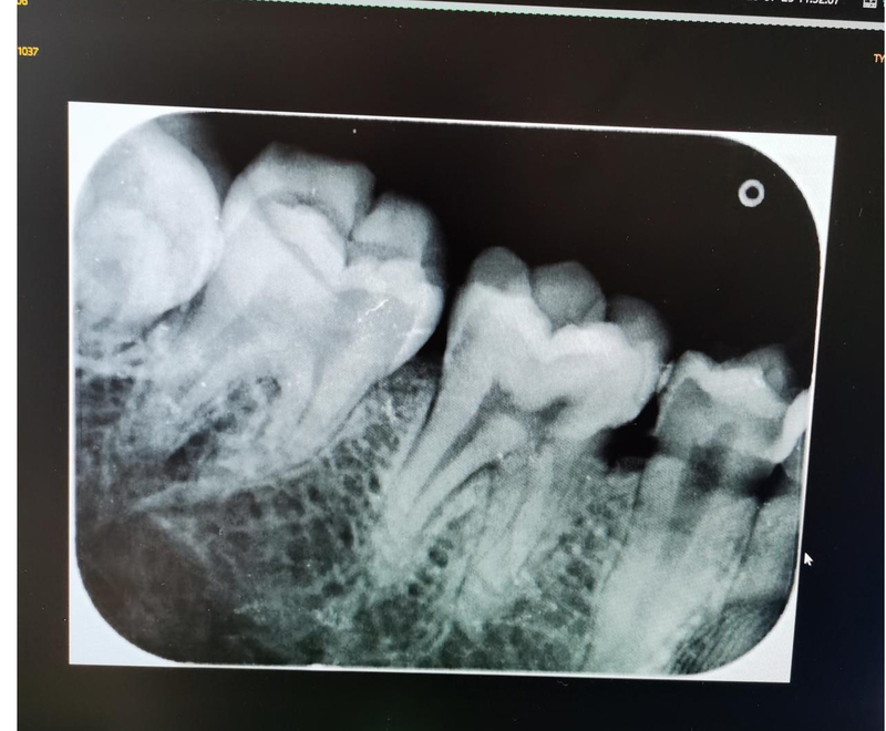 Dental Wall Mounted X Ray Machine